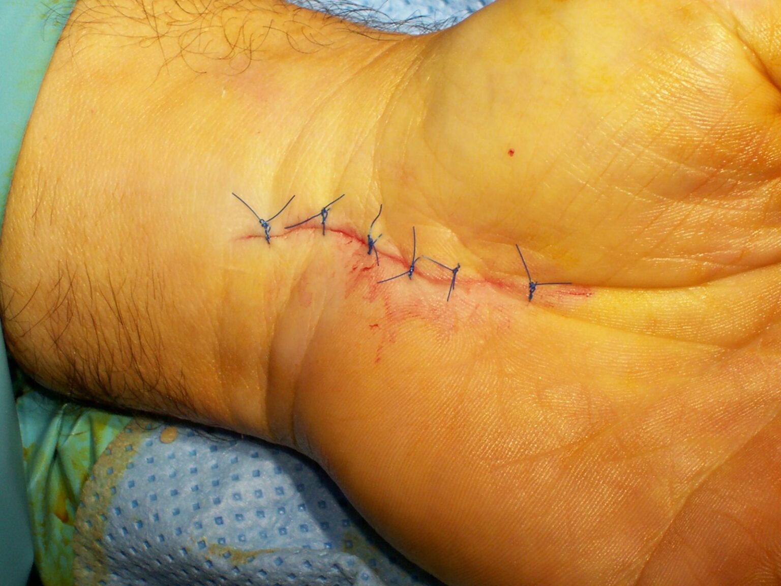 Understanding the Procedure and Benefits of Carpal Tunnel Surgery NZ